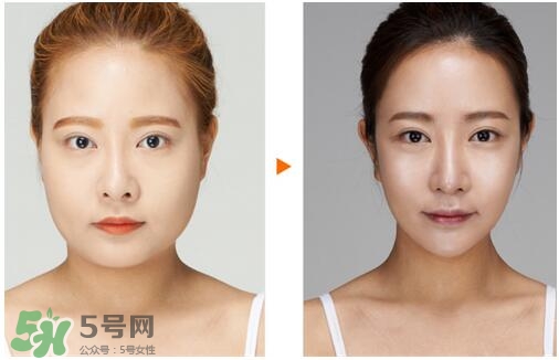 瘦臉針分為幾種類型？瘦臉針有哪幾個(gè)牌子？
