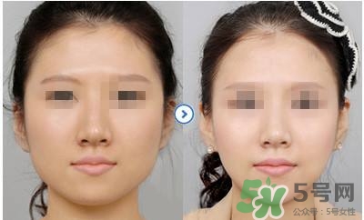 打瘦臉針疼不疼？打瘦臉針的注意事項