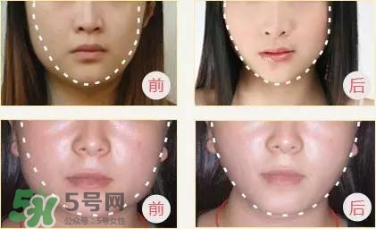 打完瘦臉針多久可以化妝？打完瘦臉針的反應