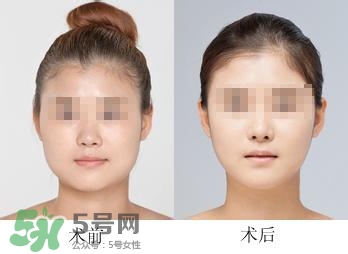 打瘦臉針能喝酒嗎？打瘦臉針能吃海鮮嗎？
