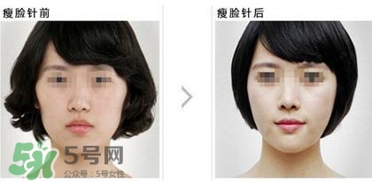 打瘦臉針能喝酒嗎？打瘦臉針能吃海鮮嗎？