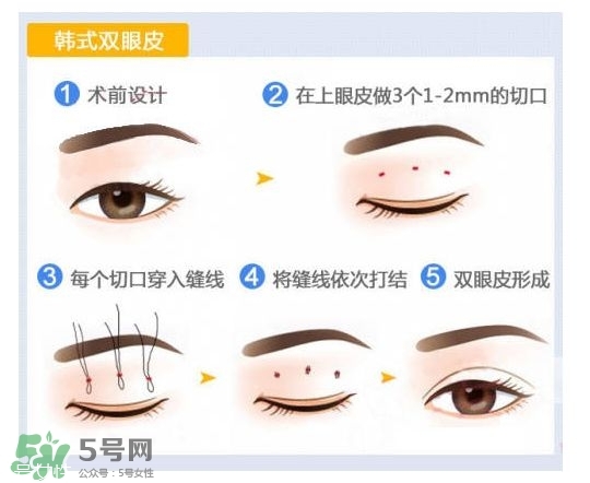 割雙眼皮有幾種做法？雙眼皮有哪幾種形狀？