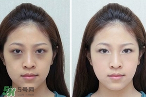 臥蠶是黑眼圈嗎？臥蠶和黑眼圈的區(qū)別