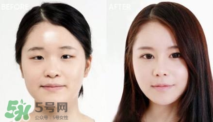 割雙眼皮有什么后遺癥嗎？割雙眼皮有什么危害性？