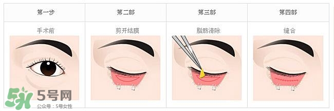 眼袋是怎么形成的？手術(shù)去眼袋安全嗎