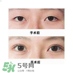 割雙眼皮疼不疼？割雙眼皮疼幾天能好？