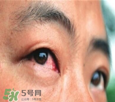 紅眼病是怎么引起的？紅眼病怎么產(chǎn)生的