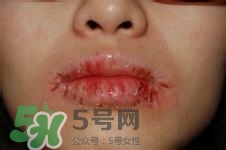 嘴唇干燥是什么原因？嘴唇干裂脫皮怎么辦？