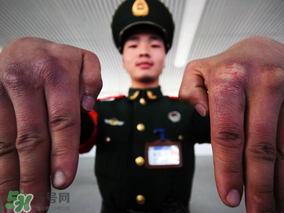 三月份還長凍瘡嗎？三月份凍瘡沒好怎么辦？