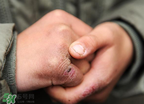 三月份還長凍瘡嗎？三月份凍瘡沒好怎么辦？