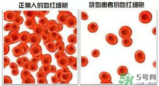 缺鐵性貧血的癥狀 缺鐵性貧血的癥狀有哪些？
