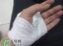 傷口化膿怎么處理？傷口化膿用什么藥好？
