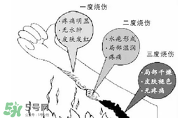 燙傷起泡要挑破嗎？燙傷起泡怎么處理？