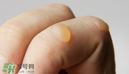 燙傷起泡要挑破嗎？燙傷起泡怎么處理？