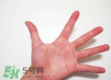 切辣椒后手很辣怎么辦？切辣椒后手很辣多久能好