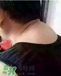 刮痧之后可以艾灸嗎？刮痧之后可不可以艾灸