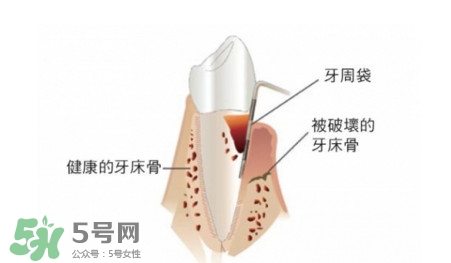牙周炎怎么治療？牙周炎怎么治好