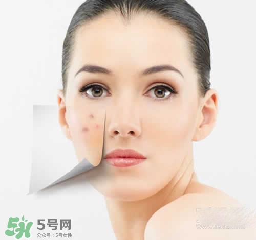 黑色痘印多久會消失？黑色痘印消失時間