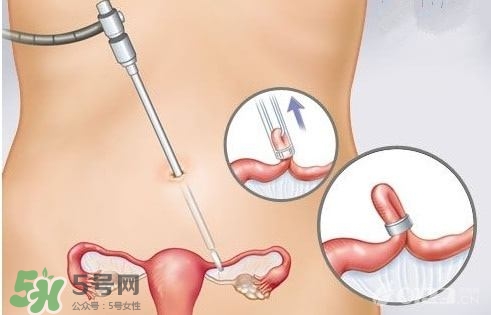 女人怎樣避孕最安全？對女人最好的避孕方法