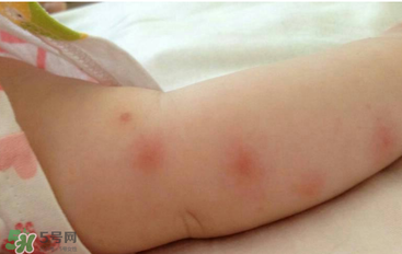 嬰兒蚊子咬了怎么消腫？嬰兒蚊子咬了怎么消腫止癢最快？