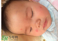 嬰兒蚊子咬了怎么消腫？嬰兒蚊子咬了怎么消腫止癢最快？