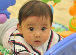 嬰兒被蚊子咬了如何去紅點(diǎn)？被蚊子咬后紅點(diǎn)如何去除？