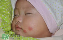 嬰兒被蚊子咬了如何去紅點(diǎn)？被蚊子咬后紅點(diǎn)如何去除？