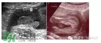 B超單數據怎么看男女？B超單看男女準嗎？