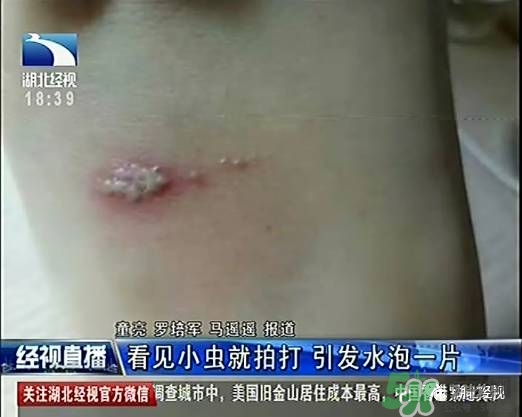 隱翅蟲有毒嗎？隱翅蟲會(huì)毀容嗎？
