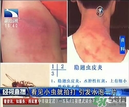 隱翅蟲有毒嗎？隱翅蟲會(huì)毀容嗎？