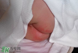 尿布疹怎么辦？寶寶尿布疹擦什么藥好？