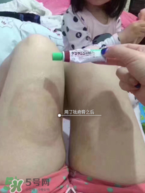 日本msd祛疤膏怎么樣？日本msd祛疤膏有用嗎？