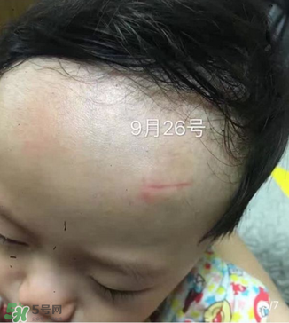 日本msd祛疤膏是抗生素嗎？日本msd祛疤膏是不是抗生素？