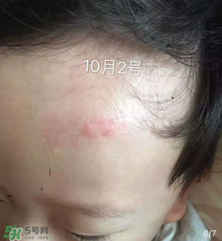 日本msd祛疤膏是抗生素嗎？日本msd祛疤膏是不是抗生素？