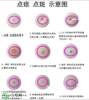 藥水點(diǎn)痣和激光點(diǎn)痣哪個(gè)好？各有什么優(yōu)缺點(diǎn)