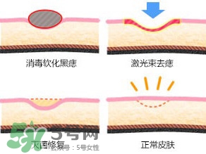 藥水點(diǎn)痣和激光點(diǎn)痣哪個(gè)好？各有什么優(yōu)缺點(diǎn)