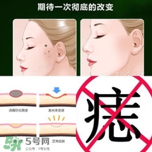 藥水點(diǎn)痣和激光點(diǎn)痣哪個(gè)好？各有什么優(yōu)缺點(diǎn)