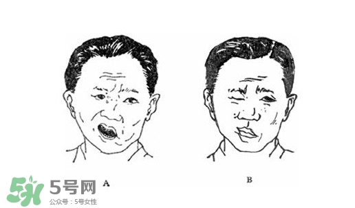 面癱是什么導(dǎo)致的？面癱多久徹底恢復(fù)正常