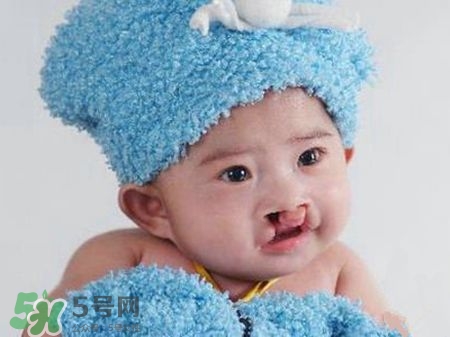 兔唇可以治嗎？兔唇修補術
