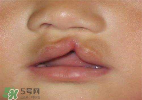 兔唇能檢查出來嗎？兔唇能完全修復嗎？