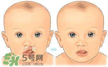 兔唇能檢查出來嗎？兔唇能完全修復嗎？