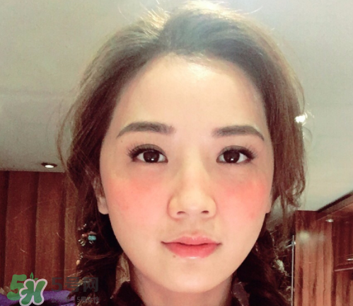 夏天可以點痣嗎？夏天點痣后要注意什么？