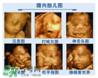 四維彩超有必要做嗎？四維彩超檢查不出什么？
