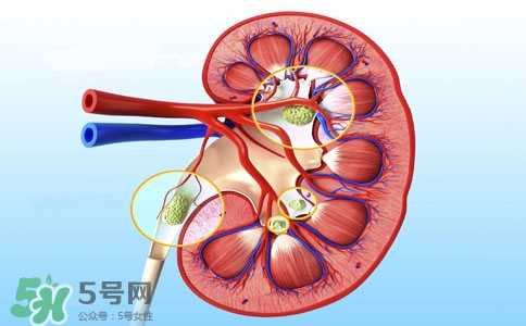 腎結(jié)石有什么癥狀？腎結(jié)石原因