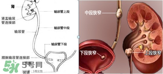 腎結(jié)石怎么治最好？腎結(jié)石的醫(yī)治方法