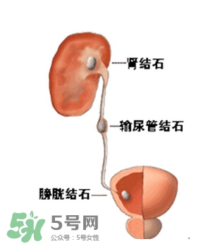 腎結(jié)石有什么癥狀？腎結(jié)石原因