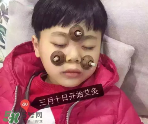 艾灸貼可以治咳嗽嗎？艾灸貼可以治退燒嗎？