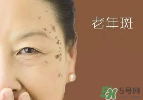 老年斑多大年齡開(kāi)始有？為什么牙膏能去老年斑？