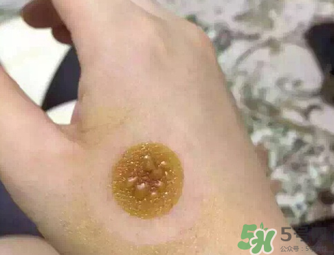 艾灸貼后有水泡怎么辦？貼艾灸貼應(yīng)注意些什么？
