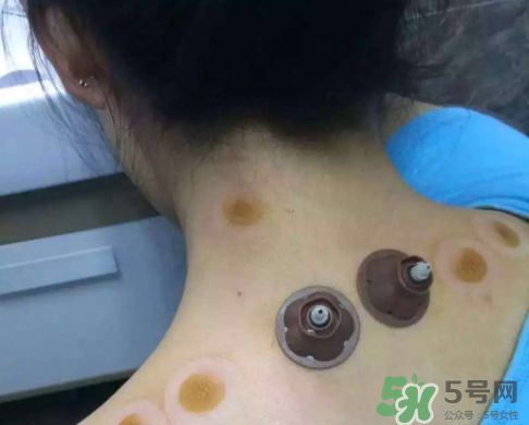 艾灸貼后有水泡怎么辦？貼艾灸貼應(yīng)注意些什么？